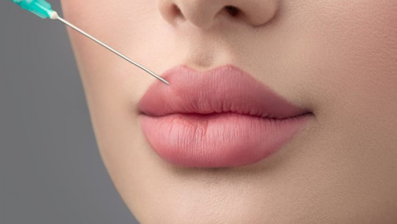 Russian Lip Fillers Treatment in Dubai: A Complete Guide for Beginners