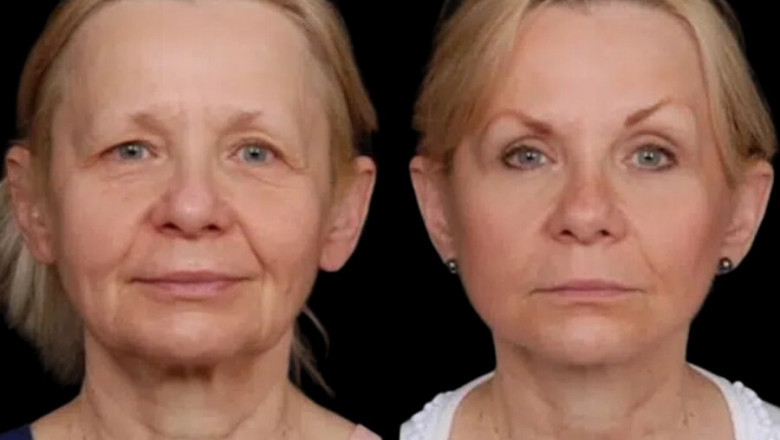 Top Clinics for Under Eye Fillers Treatment in Dubai