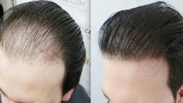 أفضل العيادات لزراعة الشعر في دبي: الجودة، التكلفة، وتجارب المرضى