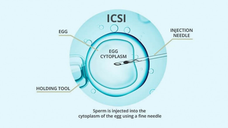 icsi treatment cost in delhi - Dr Rhythm Gupta