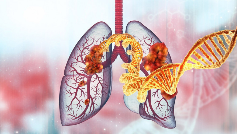 Targeted Therapy for Cancer in Delhi: Advancing Precision Oncology for Better Patient Outcomes