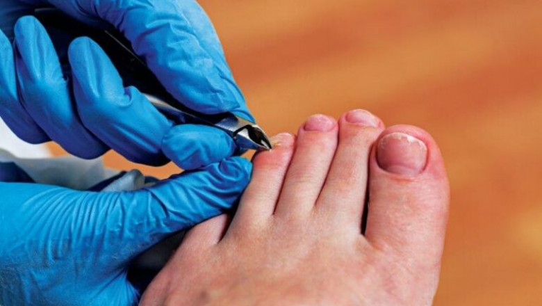 Kick Fungus to the Curb: Quick Guide to Onychomycosis Toenail Fungus