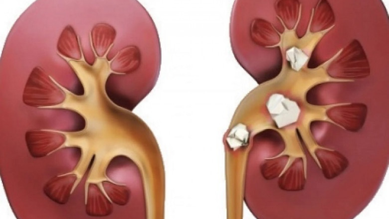 Ayurvedic Treatment For Kidney Stone: Natural Remedies to Dissolve and Prevent Stones