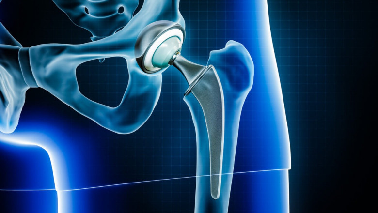 Experience Freedom from Hip Pain: Total Hip Replacement Surgery in Delhi