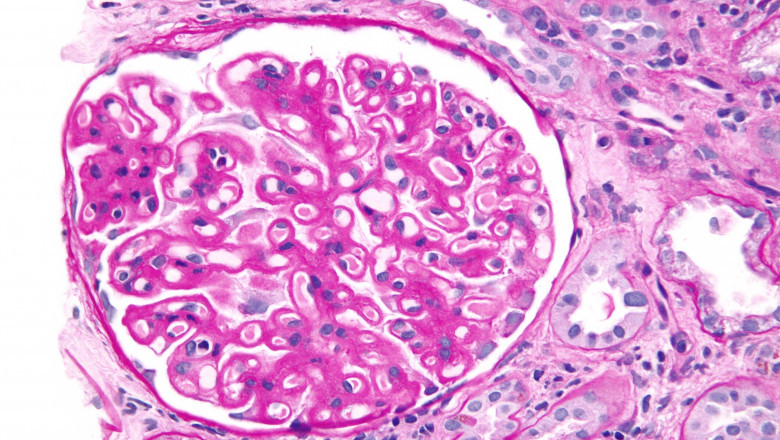 NephCure Inc.: Understanding Kidney Membranous Nephropathy and Recognizing IgA Nephropathy Symptoms