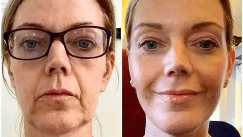 Upgrade Radiance with Profhilo by the Best Plastic Surgeons in dubai