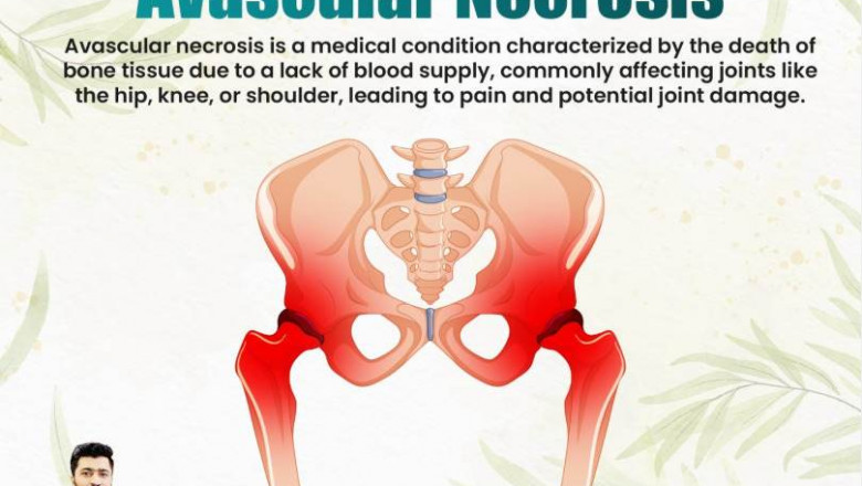 Avascular Necrosis Ayurvedic Treatment in India – Natural Healing and Effective Relief