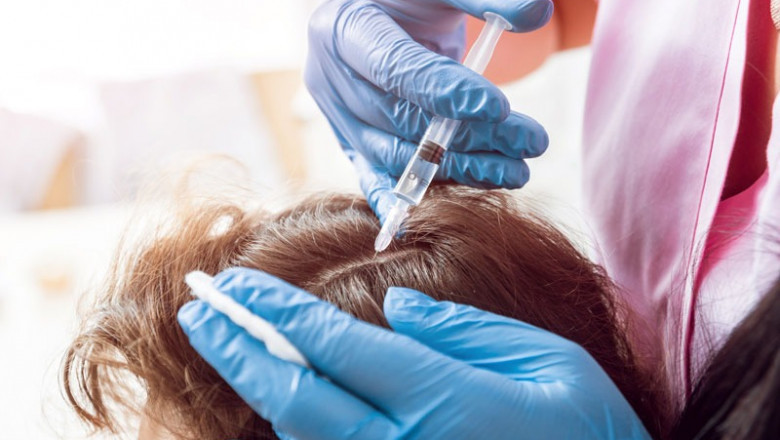 PRP Therapy for Hair Loss: Safe, Natural, and Effective Regrowth Without Surgery