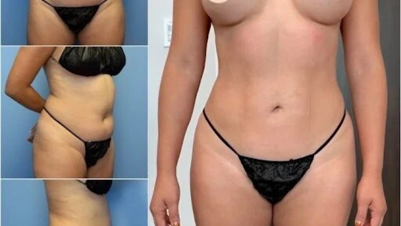 The Ultimate Guide to Finding the Best Body Contouring Surgeon in dubai