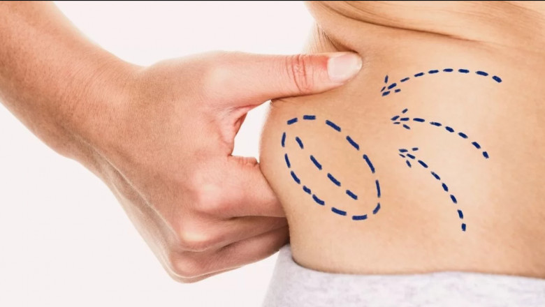 What to Know Before Liposuction Insights from Best Liposuction Surgeon in Dubai