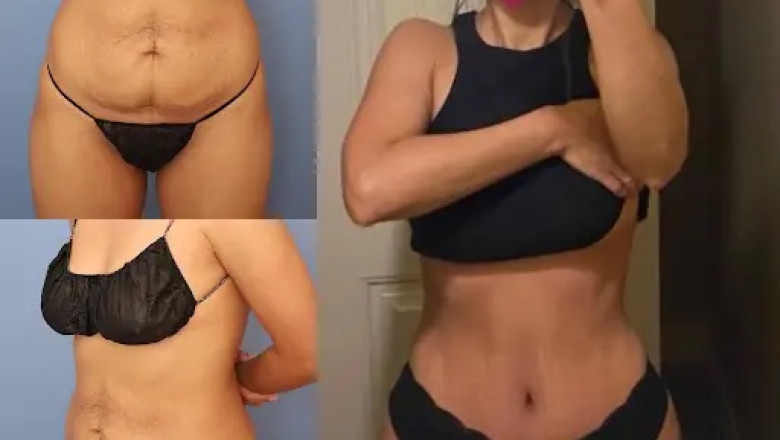 Why Experience Matters When Choosing the Best Tummy Tuck Surgeon in dubai