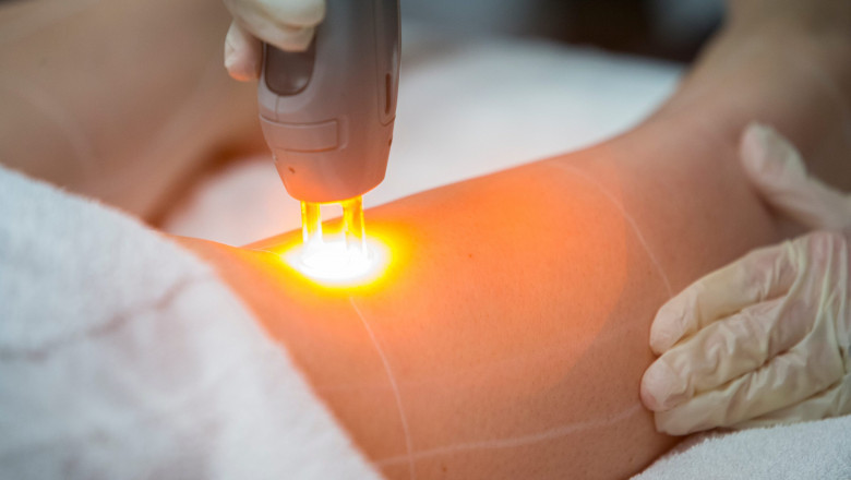 5 Must‑Try Laser Treatments Boosting Confidence