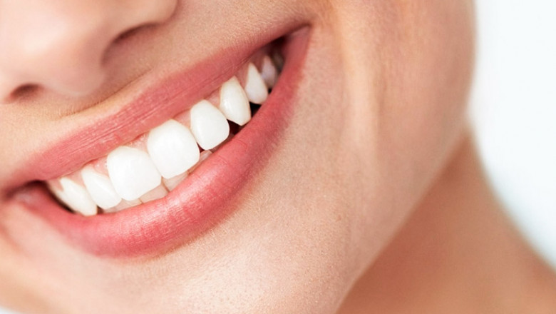 Does My Smile Teeth Whitening Kit Require Any Special Preparation?