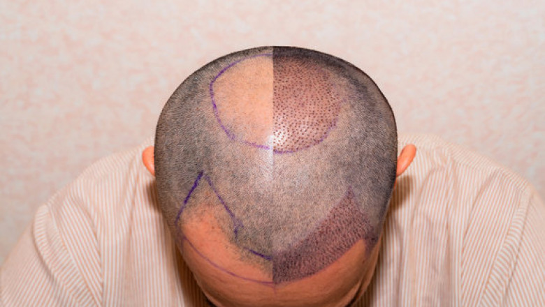 Frequently Asked Questions About Hair Transplantation—Answered!