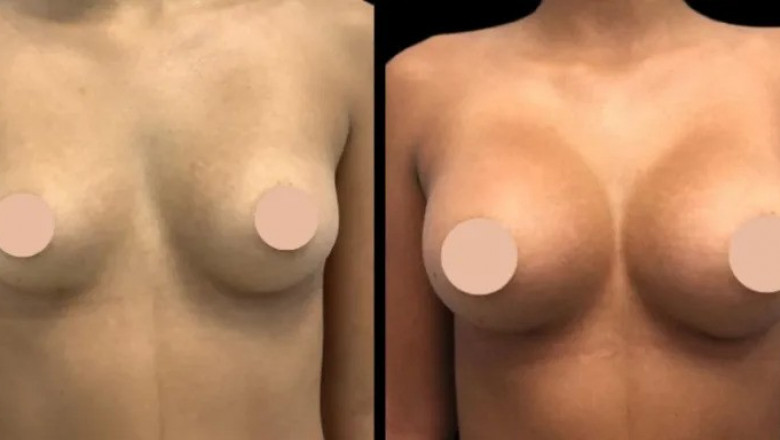 How to Choose the Best Breast Augmentation Surgeons in Dubai for Your Desired Results