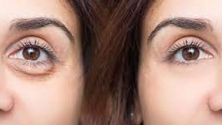 The Cost Factor: Understanding the Investment in Different Eye Bag Reduction Treatments in Dubai