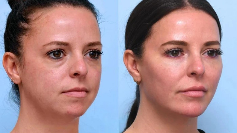 What to Expect Before and After Thread Lift Treatment in Dubai