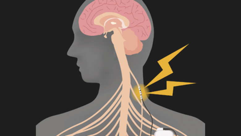 Break Free from Facial Pain with Implanted Nerve Devices