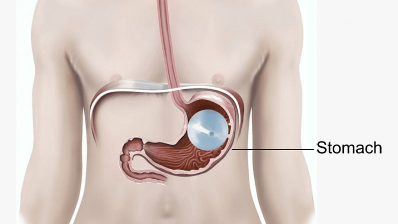 Comparing the Gastric Balloon to Other Weight Loss Procedures Available in Dubai