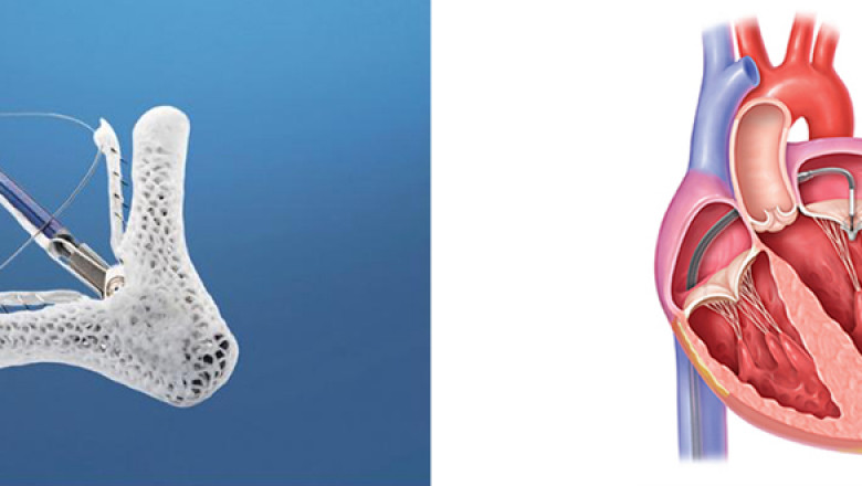 Germany Mitral Valve Disease Market: A Booming Opportunity for Medical Device Companies