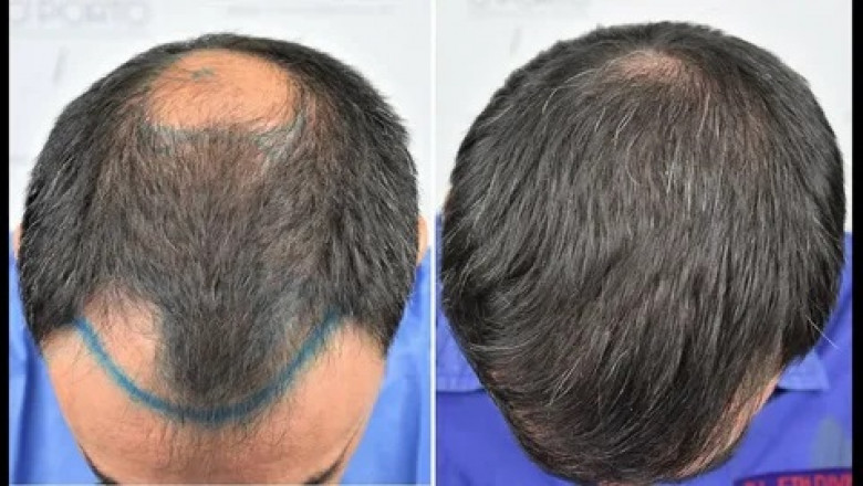 Finding Reputable and Experienced Hair Transplant Clinics and Surgeons in Dubai