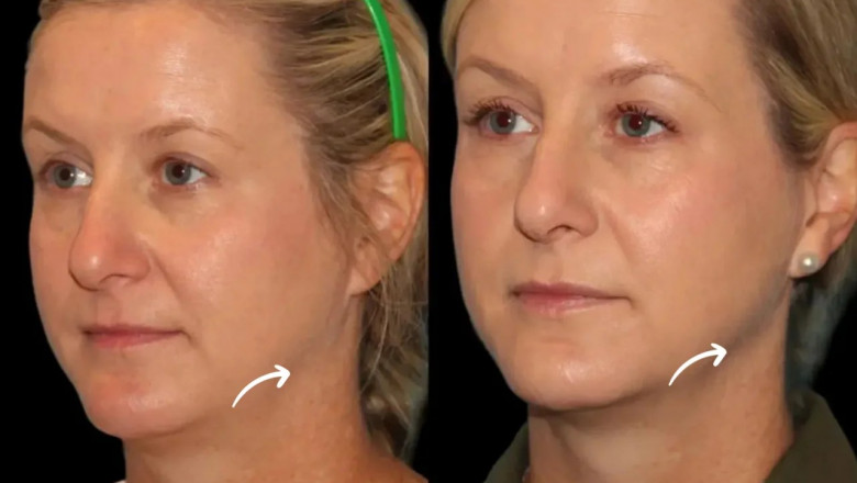 Are You Choosing the Best Aesthetic Clinics in Dubai for Sculptra Fillers?