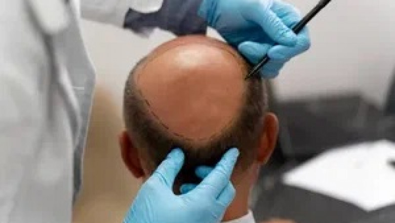 Patient Testimonials and Before & After Gallery for Hair Transplants in Abu Dhabi: Why Real Experiences Matter