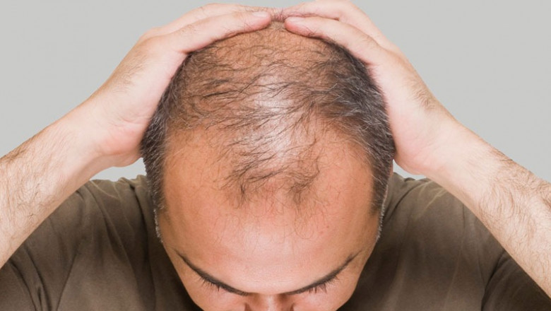 Understanding Hair Transplant Surgery in Delhi: Procedure, Benefits & Pricing