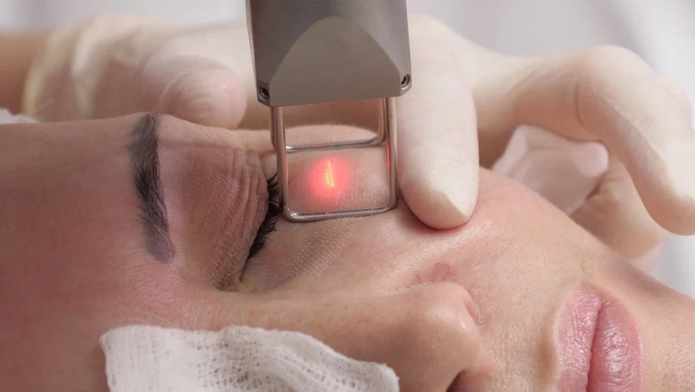 Fractional Laser: Scarless Healing