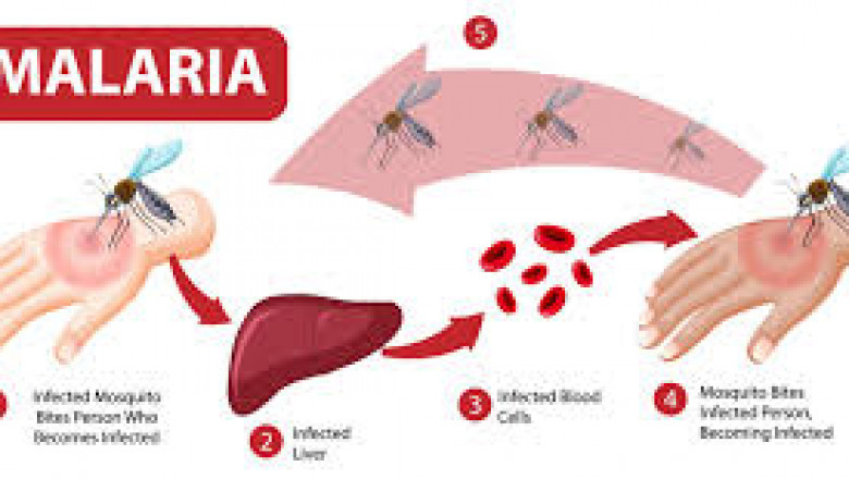 How Malaria Spreads and Smart Ways to Prevent It