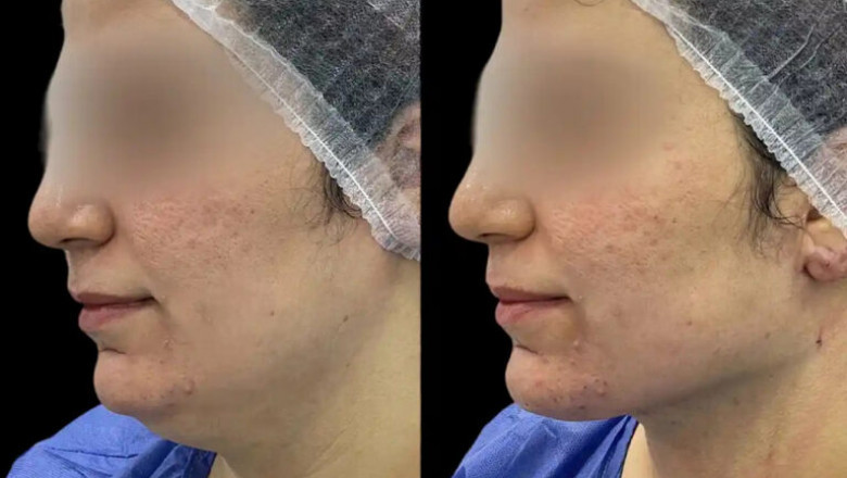 What to Expect from Chin Fillers Treatments with the Best Plastic Surgeons in dubai