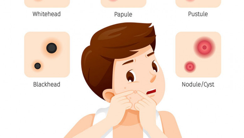 Tretiva 40 mg: A Game-Changer for Severe and Cystic Acne