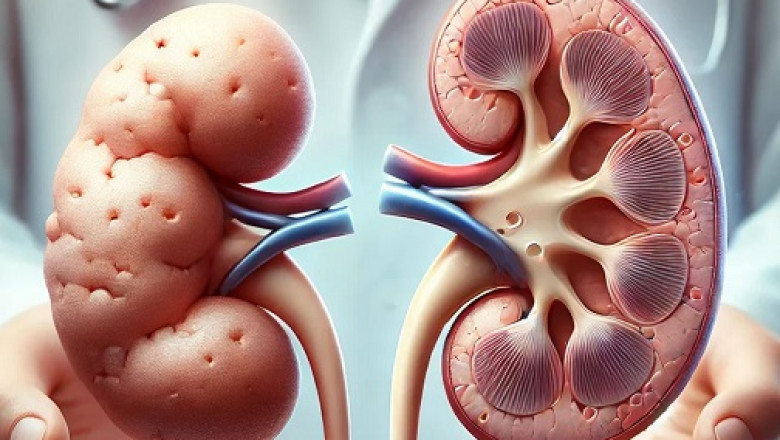 Ayurvedic Treatment For Kidney Shrinkage: Natural Remedies to Restore Kidney Size