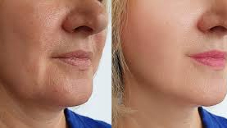 Skulptera Din Profil Naturligt med Fillers Haka i Stockholm