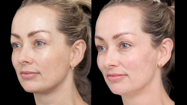 Can You Combine Cheek Fillers Treatment in Dubai with Other Treatments?