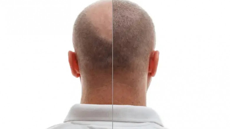 Hair Transplantation and PRP Therapy