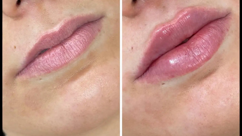 The Benefits of Russian Lip Fillers Treatment in Dubai for Overly Thin Lips