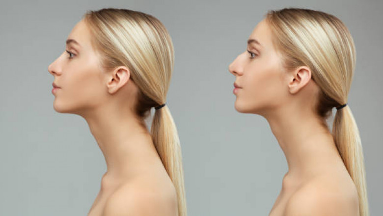 تواصل مع أفضل أخصائي تجميل أنف في الرياض
