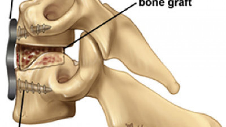 ACDF Surgery