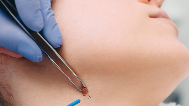 How do you know if a mole is changing?