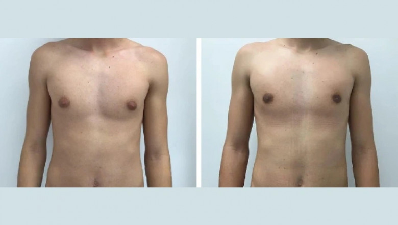 Choosing The Best Gynecomastia Surgeons in dubai For Lasting Results