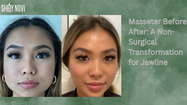 Masseter Before After: A Non-Surgical Transformation for Jawline