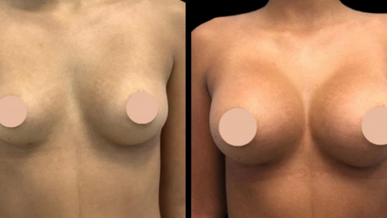 Affordable Excellence: Best Breast Augmentation Surgeons in Dubai on a Budget