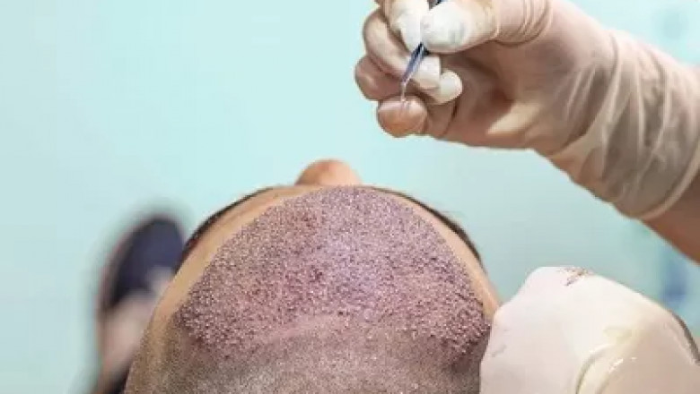 Hair Transplant Surgery in Dubai: Best Clinics and Pricing Explained