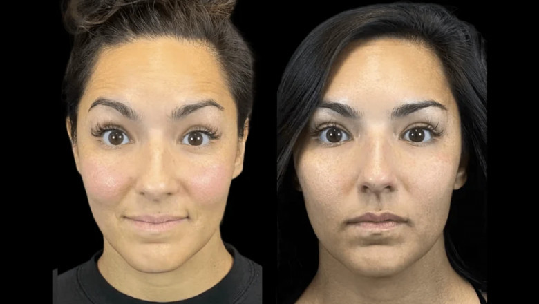 Men and Botox: A Growing Trend at the Best Aesthetic Clinic in dubai