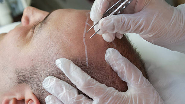 Dubai Hair Transplants: What You Should Know