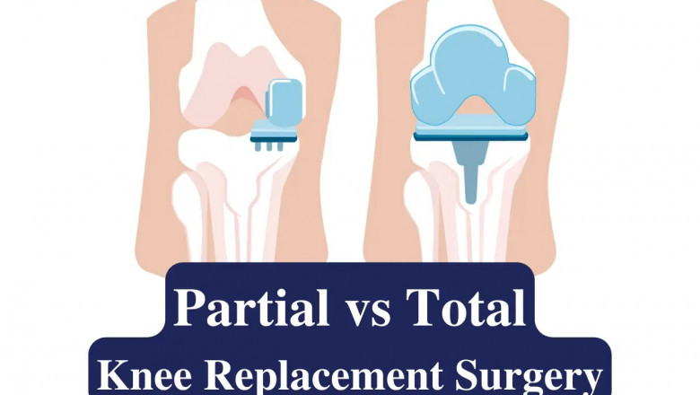 Partial vs. Total Knee Replacement: Understanding Your Best Treatment Option