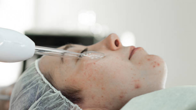 Pimples Treatment in Dubai: Sensitive Skin Care