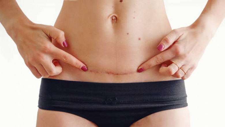 Scar Removal for Darker Skin Types in Dubai