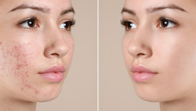 Best Acne Scar Treatment in Delhi – Get Results That Last